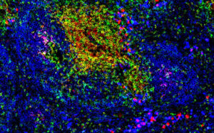 A microscopic image of immune cells in the spleen. Immune therapies are being researched as part of trying to find a cure for type 1 diabetes.