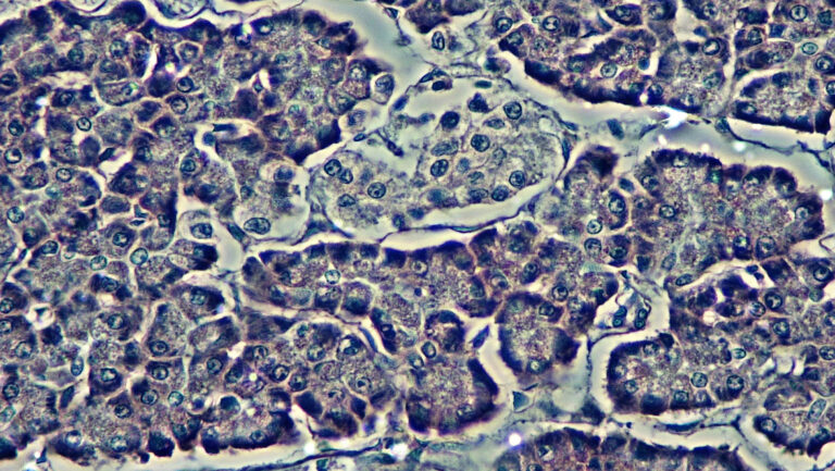 Islet Example Islet transplants | Breakthrough T1D UK